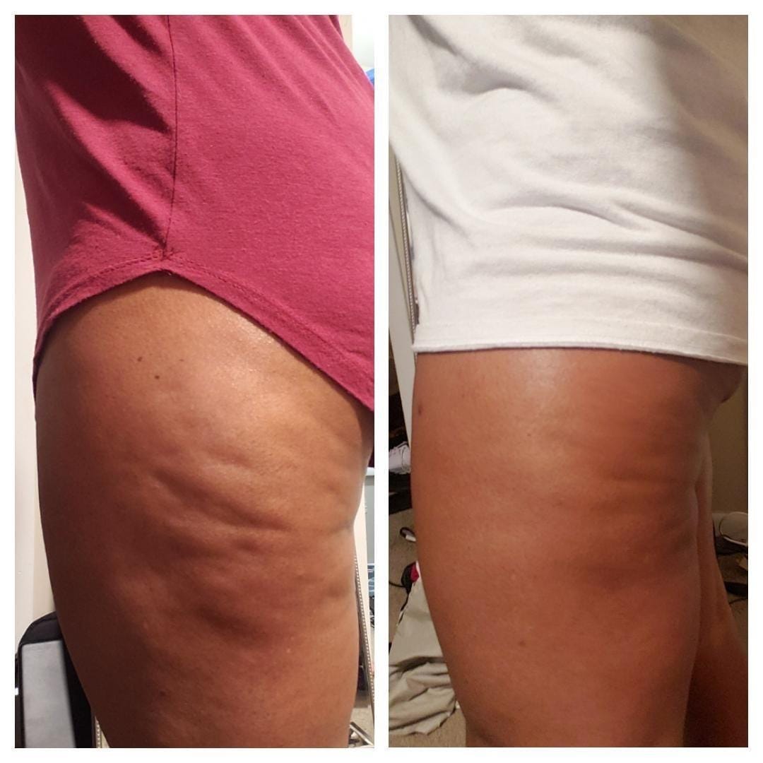 Anti-Cellulite Massage Oil - Trending Wellness Store